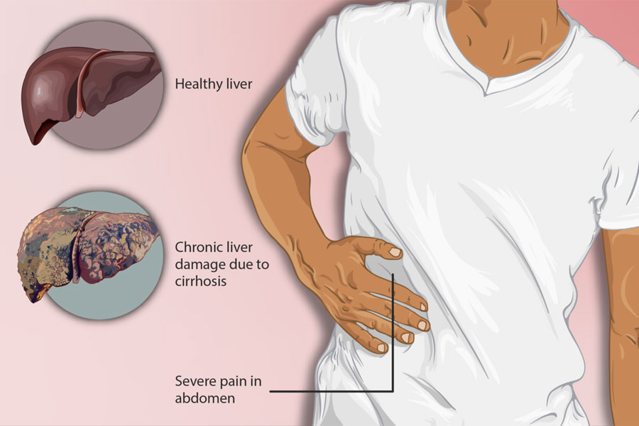 You are currently viewing Liver Cirrhosis. Things One Should Know