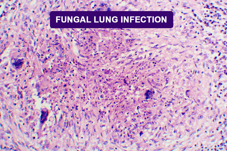 Read more about the article Fungal Lung Infections and How to Strengthen Your Immune System